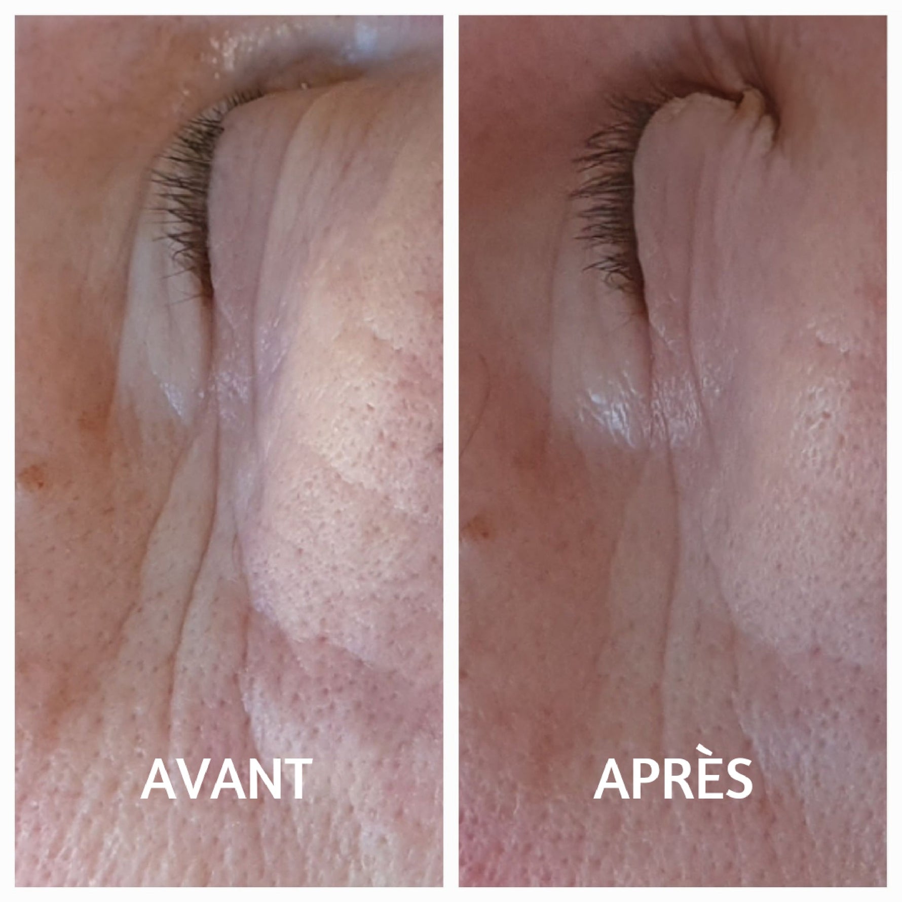 Ridule visage : comment les reconnaître et les atténuer